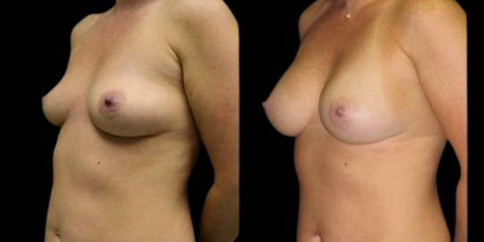This is a 36-year-old female that has had a breast augmentation and implant showing the before and after's side-by-side