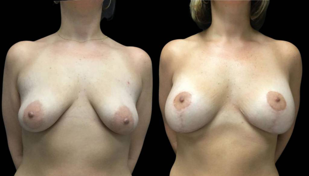36-year-old-female-breast-lift-with-augmentation-before-and-after-front-view-26035.jpg