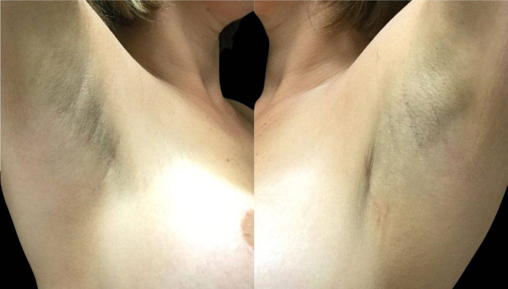 36-year-old-female-breast-lift-with-augmentation-before-and-after-front-view.jpg