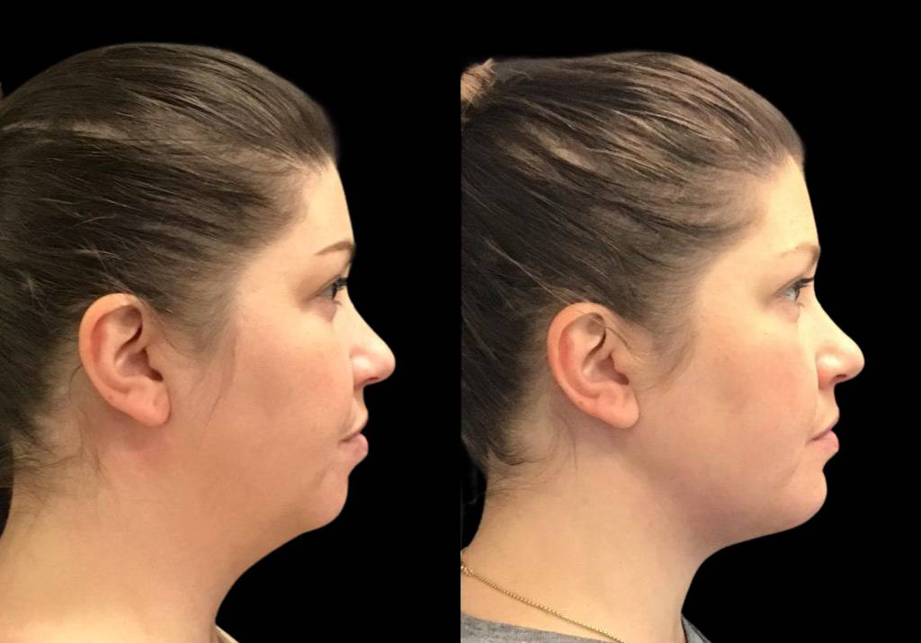 36-year-old-female-chin-implant-before-and-after-side-view.jpg