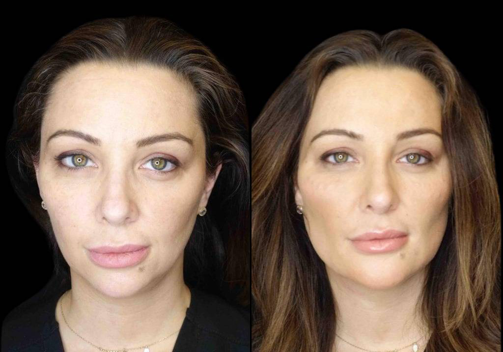 36-year-old-female-model-lift-before-and-after-front-view-29564.jpg