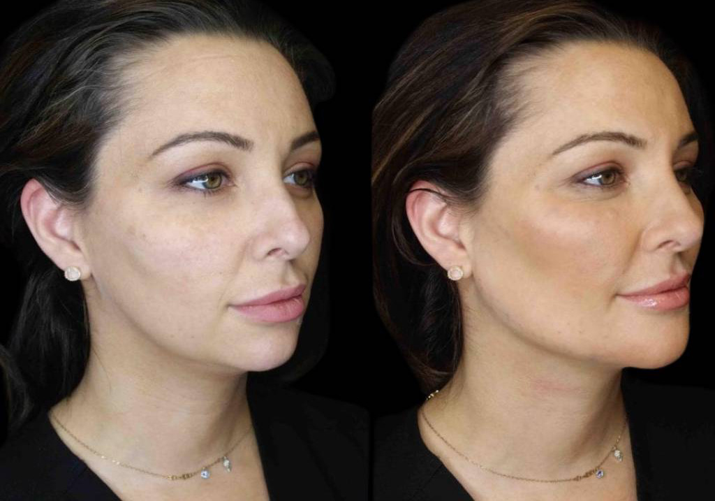 36-year-old-female-model-lift-before-and-after-three-quarter-view-2.jpg