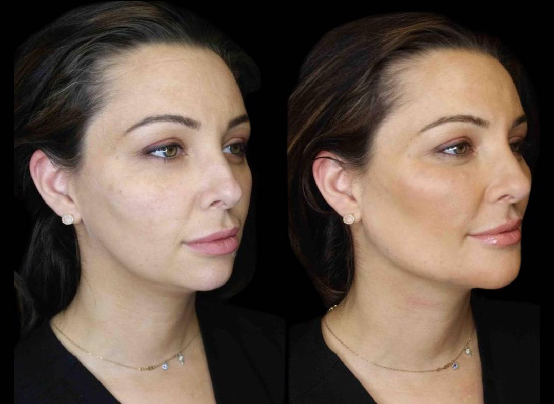 36-year-old-female-model-lift-before-and-after-three-quarter-view-2.jpg
