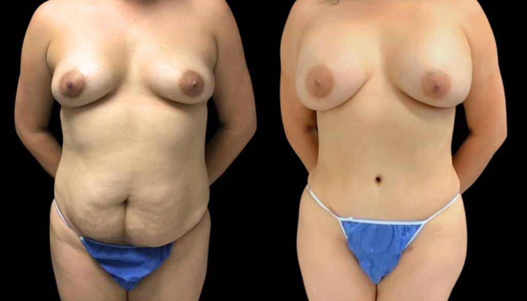 36-year-old-female-mommy-makeover-body-before-and-after-front-view-28591.jpg