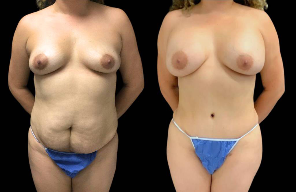 36-year-old-female-mommy-makeover-body-before-and-after-front-view-28591.jpg