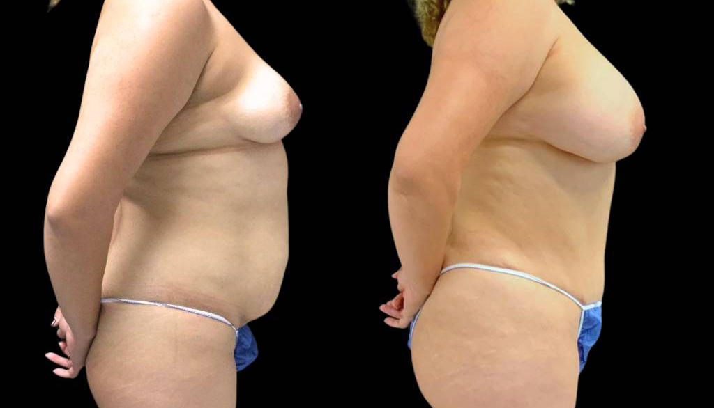 36-year-old-female-mommy-makeover-body-before-and-after-side-view.jpg