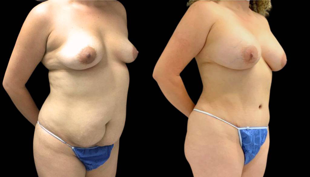 36-year-old-female-mommy-makeover-body-before-and-after-three-quarters-view.jpg