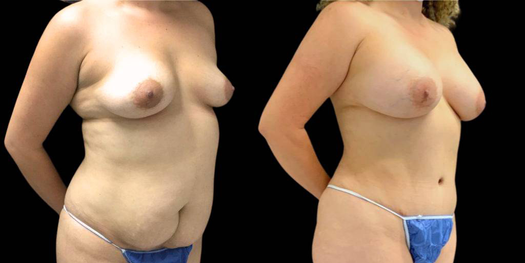 This is a 36-year-old female that has had a breast augmentation showing the before and after's side-by-side