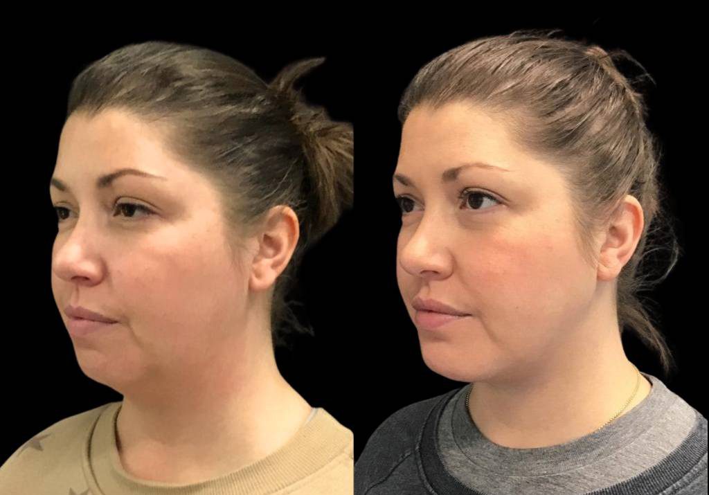 36-year-old-female-non-surgical-facelift-before-and-after-three-quarters-view-32783.jpg