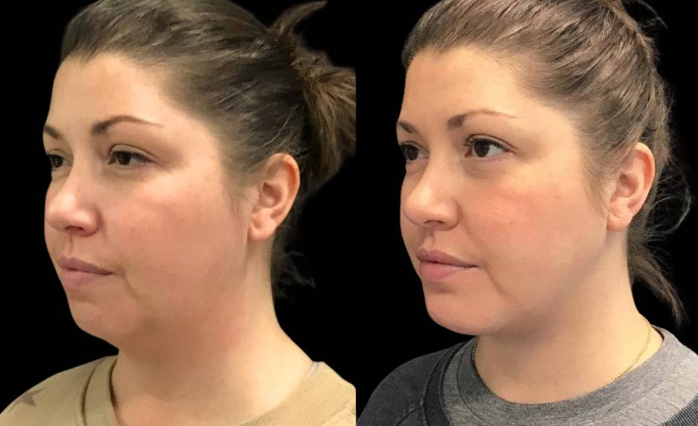 36-year-old-female-non-surgical-facelift-before-and-after-three-quarters-view-32783.jpg
