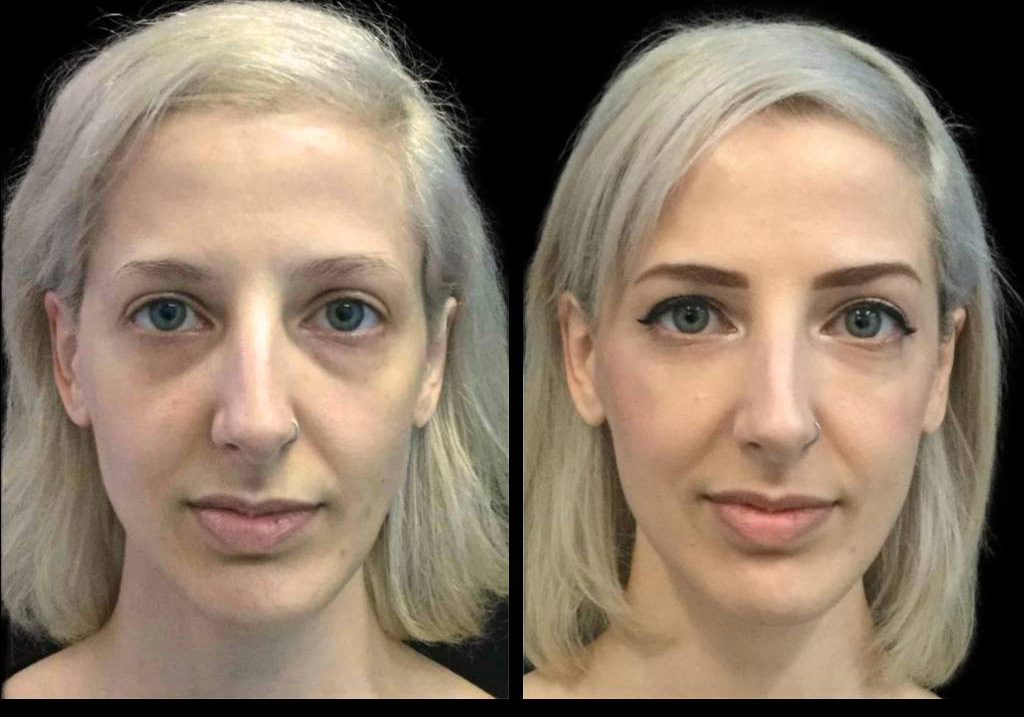 36-year-old-female-restylane-before-and-after-front-view-27120.jpg