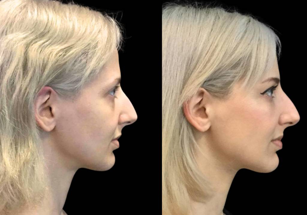 36-year-old-female-restylane-before-and-after-side-view.jpg