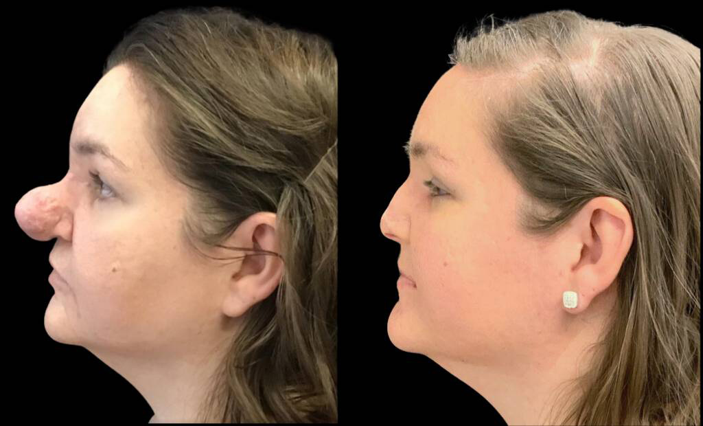 36-year-old-female-rhinophyma-reduction-before-and-after-front-view-.jpg