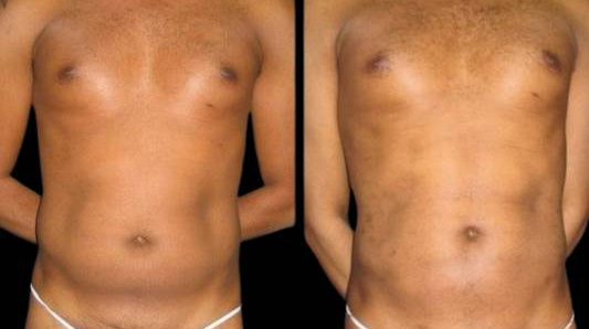This is a 36-year-old male that has had an abdominal etching done showing the before and after's side-by-side