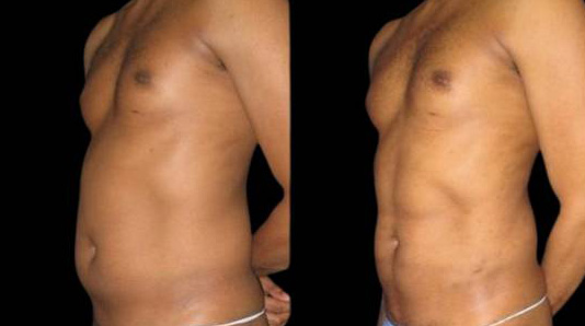 This is a 36-year-old male that has had an abdominal etching done showing the before and after's side-by-side