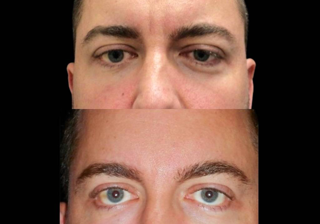 36-year-old-male-restylane-before-and-after-front-view-13474.jpg