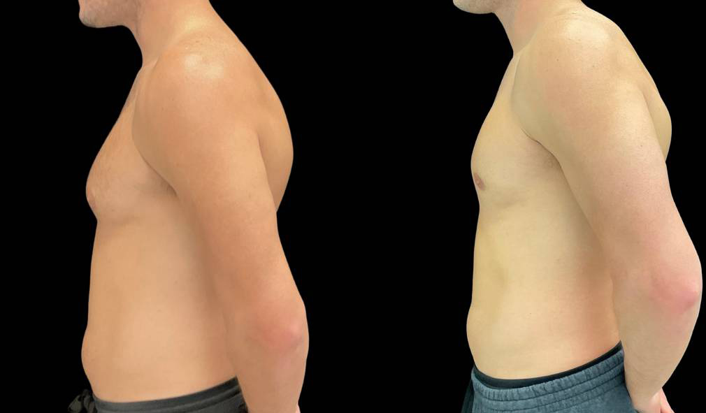 36-yr-old-male-gynecomastia-before-and-after-left-view-1.jpg