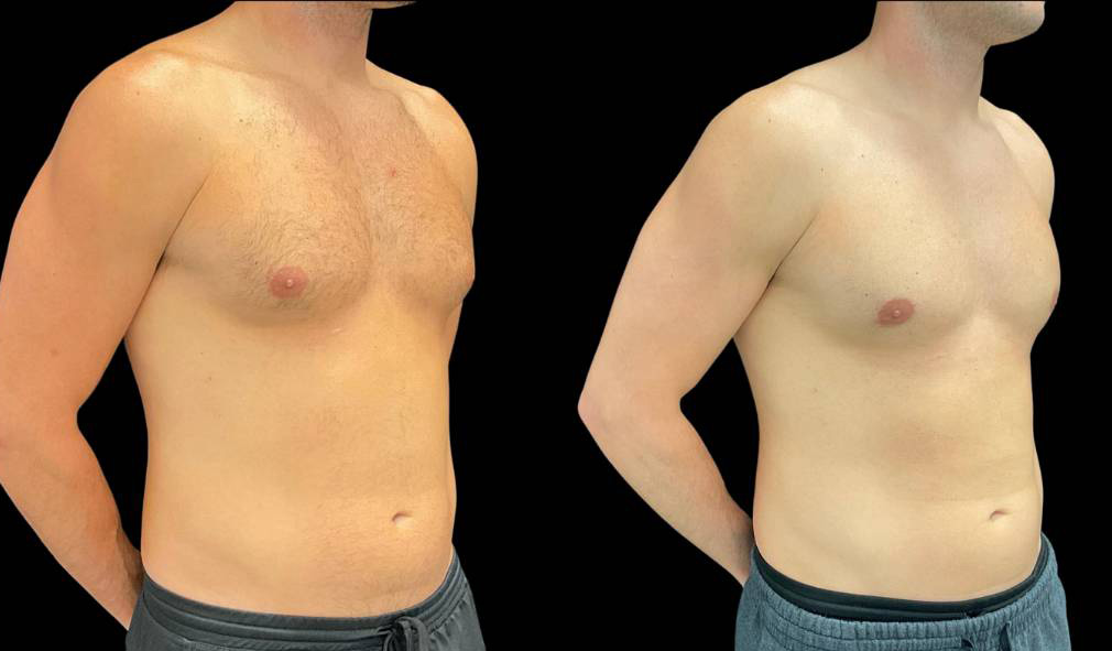 36-yr-old-male-gynecomastia-before-and-after-right-three-quarter-view.jpg