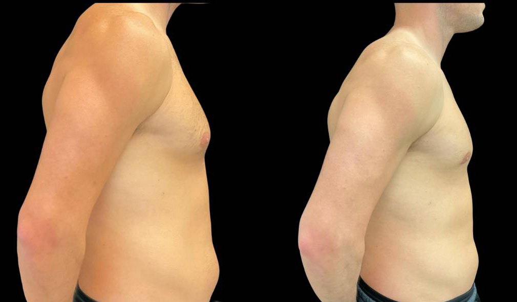36-yr-old-male-gynecomastia-before-and-after-right-view.jpg