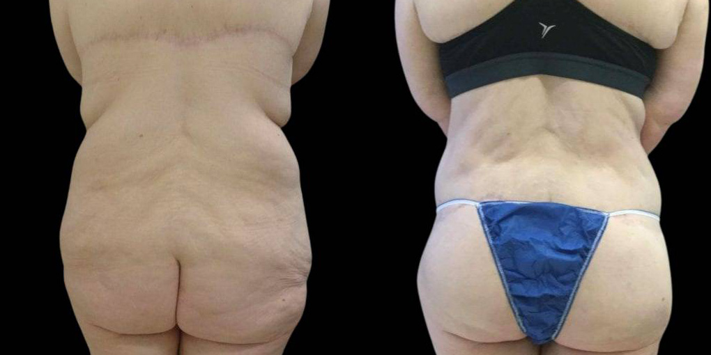 This is a female that has had surgery after weight loss showing the before and after's side-by-side