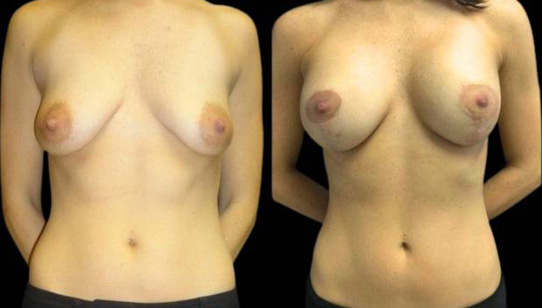 37-year-old-female-breast-lift-with-augmentation-before-and-after-front-view-18790.jpg