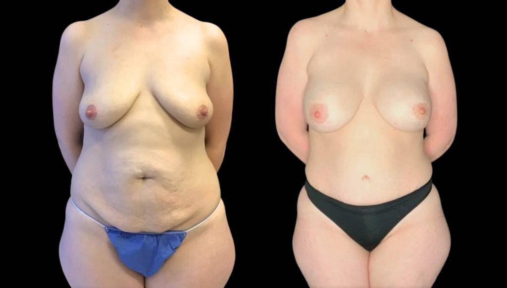 37-year-old-female-breast-lift-with-augmentation-before-and-after-front-view-29555.jpg