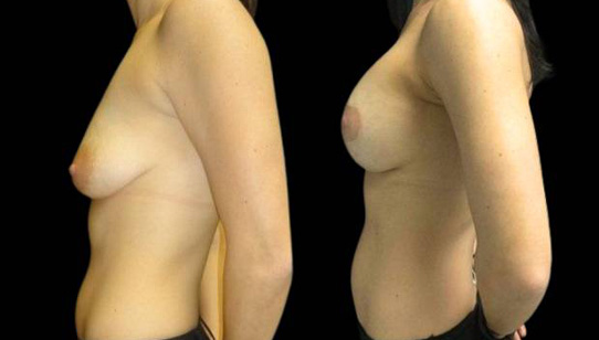 37-year-old-female-breast-lift-with-augmentation-before-and-after-side-view-1.jpg