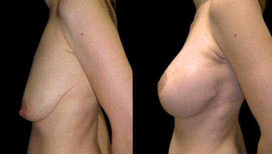 37-year-old-female-breast-lift-with-augmentation-before-and-after-side-view-2-1.jpg