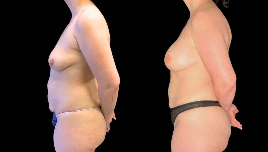 37-year-old-female-breast-lift-with-augmentation-before-and-after-side-view-2.jpg