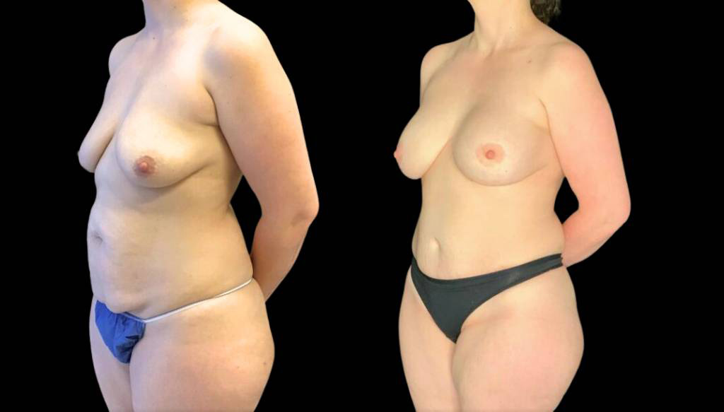 37-year-old-female-breast-lift-with-augmentation-before-and-after-three-quarter-view-2.jpg
