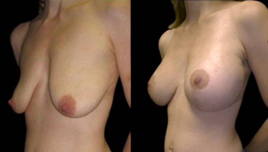 37-year-old-female-breast-lift-with-augmentation-before-and-after-three-quarter-view-4123.jpg