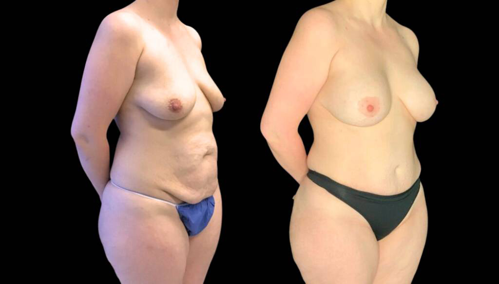 37-year-old-female-breast-lift-with-augmentation-before-and-after-three-quarter-view.jpg