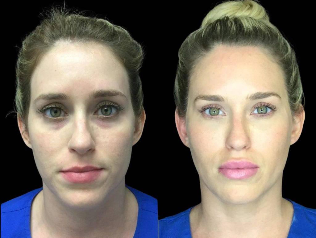 37-year-old-female-model-lift-before-and-after-front-view.jpg