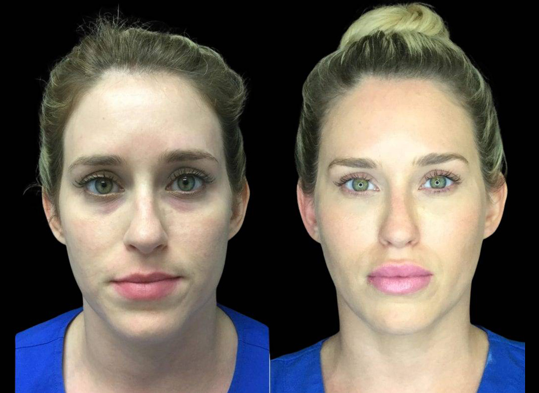 37-year-old-female-model-lift-before-and-after-front-view.jpg