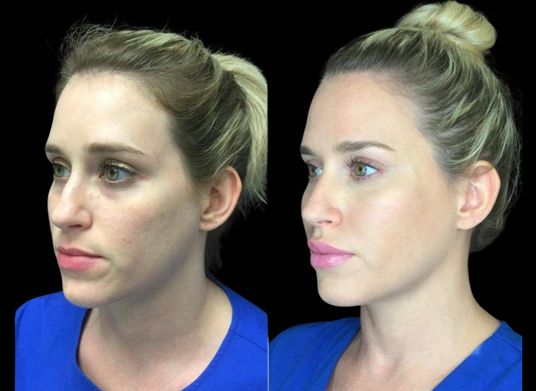 37-year-old-female-model-lift-before-and-after-three-quarter-view-25283.jpg