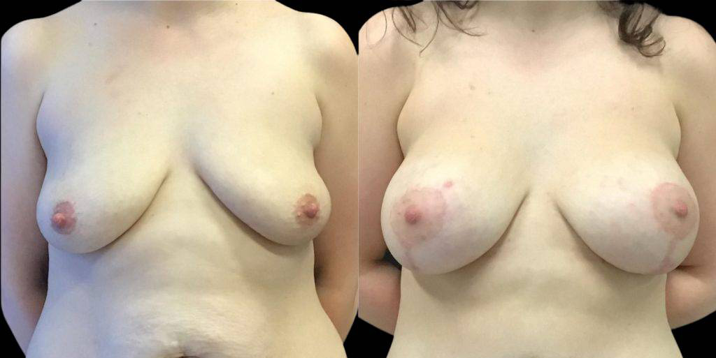 This is a 37-year-old female that has had a mommy makeover showing the before and after's side-by-side