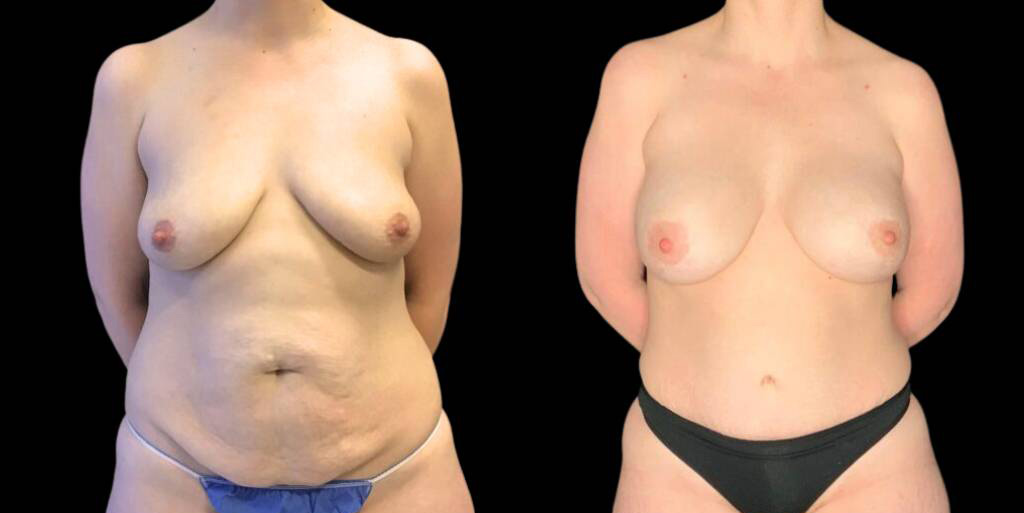 37-year-old-female-mommy-makeover-body-before-and-after-front-view.jpg