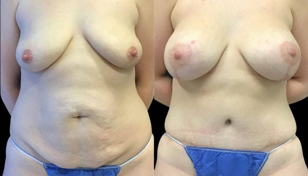 37-year-old-female-mommy-makeover-body-before-and-after-front-view-1.jpg