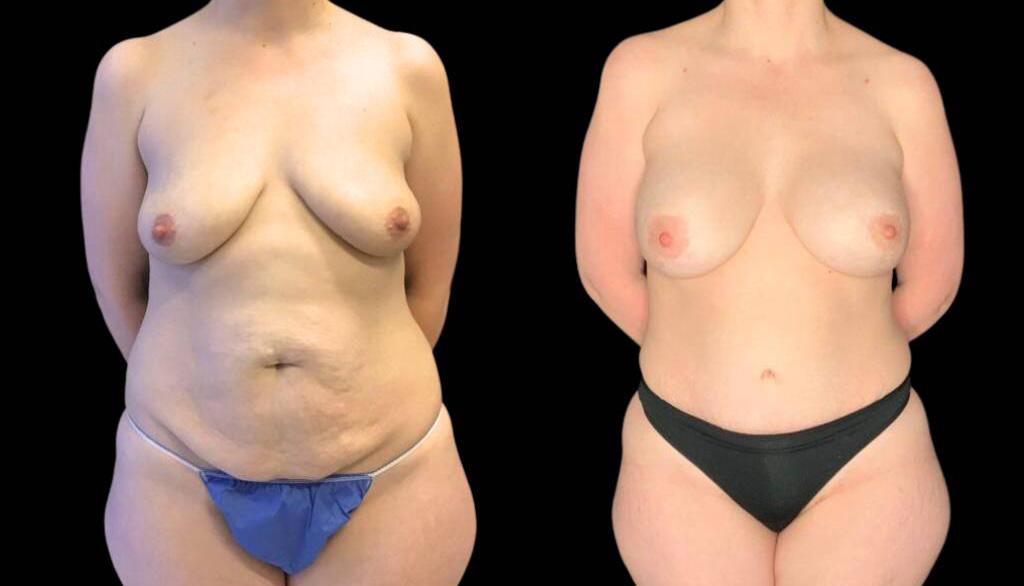 37-year-old-female-mommy-makeover-body-before-and-after-front-view.jpg