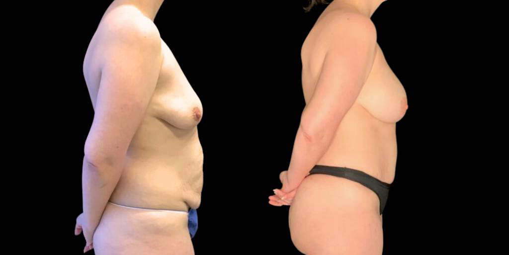 This is a 37-year-old female that has had a breast augmentation and implant showing the before and after's side-by-side