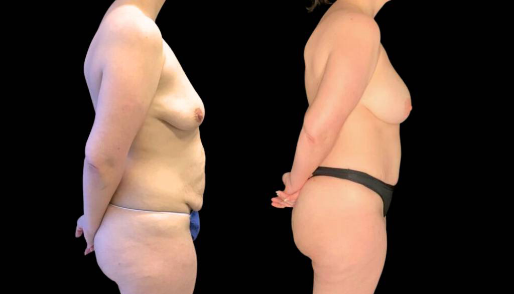 37-year-old-female-mommy-makeover-body-before-and-after-side-view.jpg