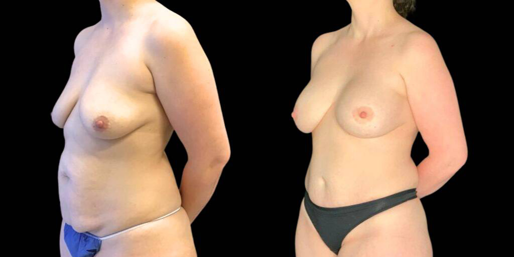 This is a 37-year-old female that has had a breast augmentation and implant showing the before and after's side-by-side