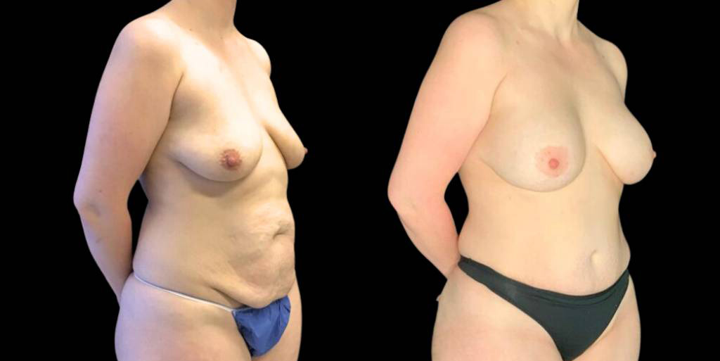 This is a 37-year-old female that has had a breast augmentation and implant showing the before and after's side-by-side