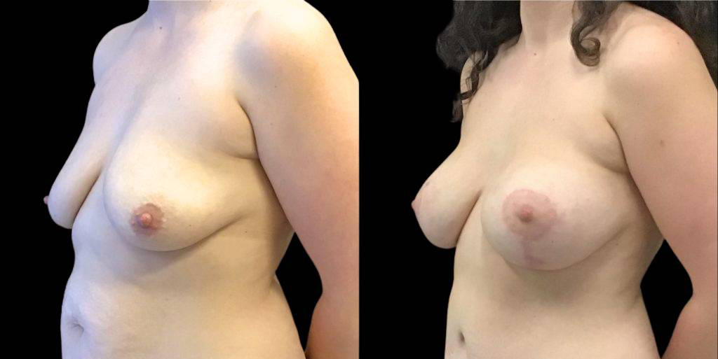 This is a 37-year-old female that has had a mommy makeover showing the before and after's side-by-side