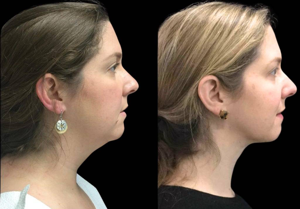 37-year-old-female-neck-liposuction-before-and-after-side-view-1.jpg