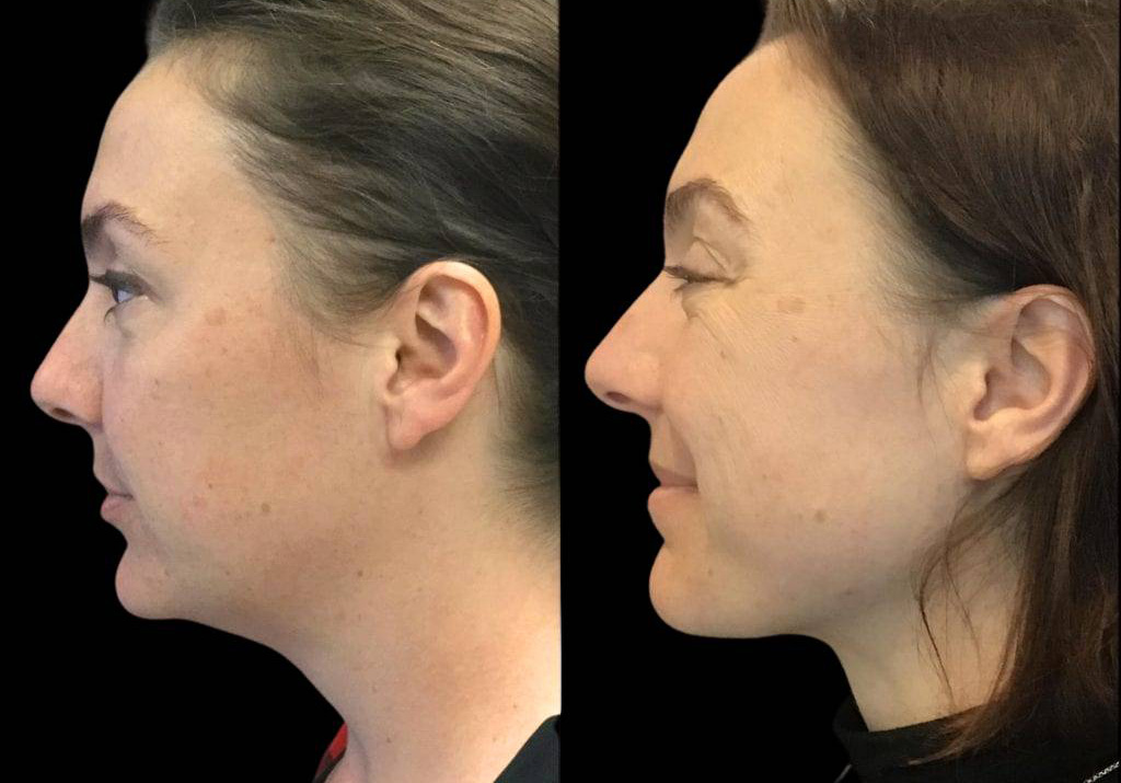 37-year-old-female-neck-liposuction-before-and-after-side-view-27648.jpg