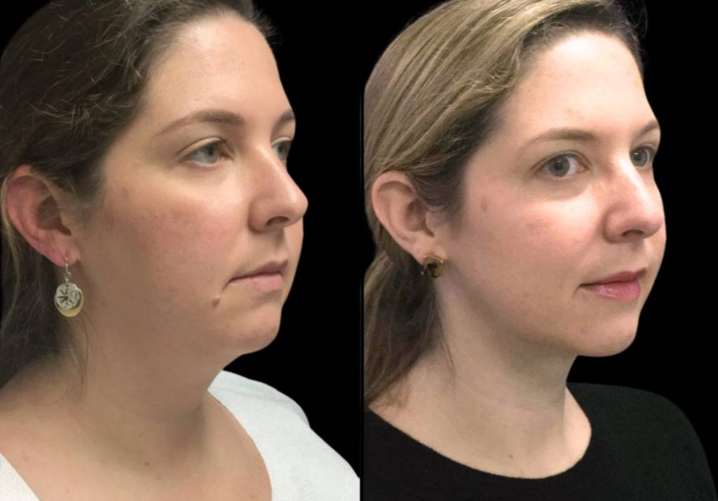 37-year-old-female-neck-liposuction-before-and-after-three-quarter-view-1.jpg