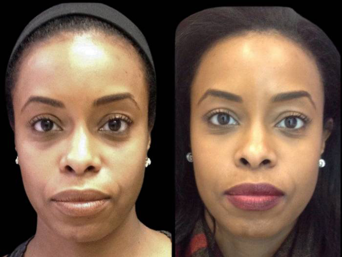 37-year-old-female-non-surgical-cheek-augmentation-before-and-after-front-view-19204.jpg
