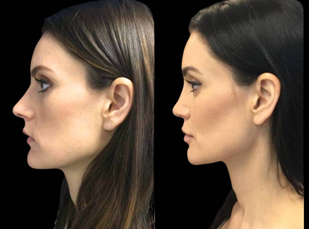 37-year-old-female-rhinoplasty-before-and-after-side-view-1.jpg
