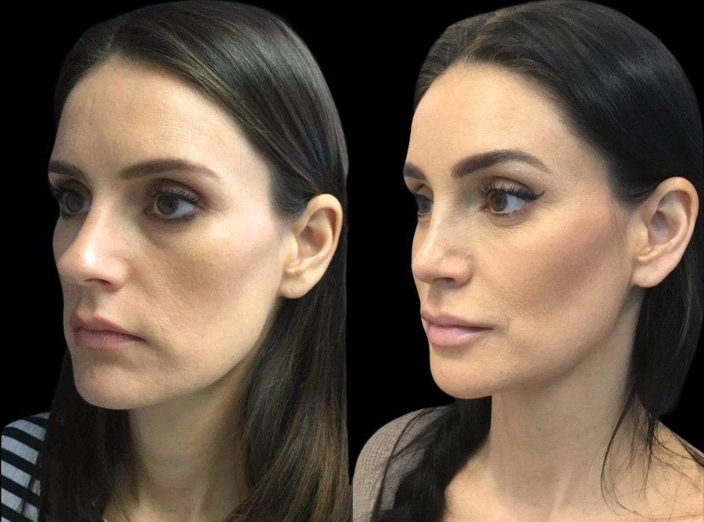 37-year-old-female-rhinoplasty-before-and-after-three-quarters-view-1.jpg